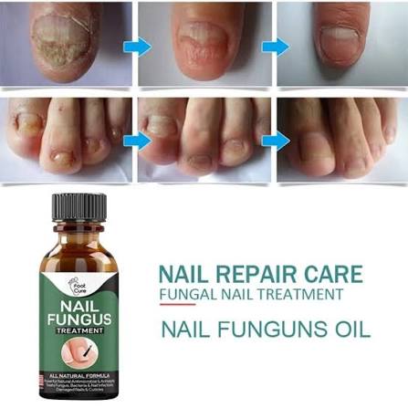 Foot Cure Nail Fungus Treatment – Anti-Microbial & Antiseptic Nail Repair Oil for Toenail & Fingernail Fungus | 10ml